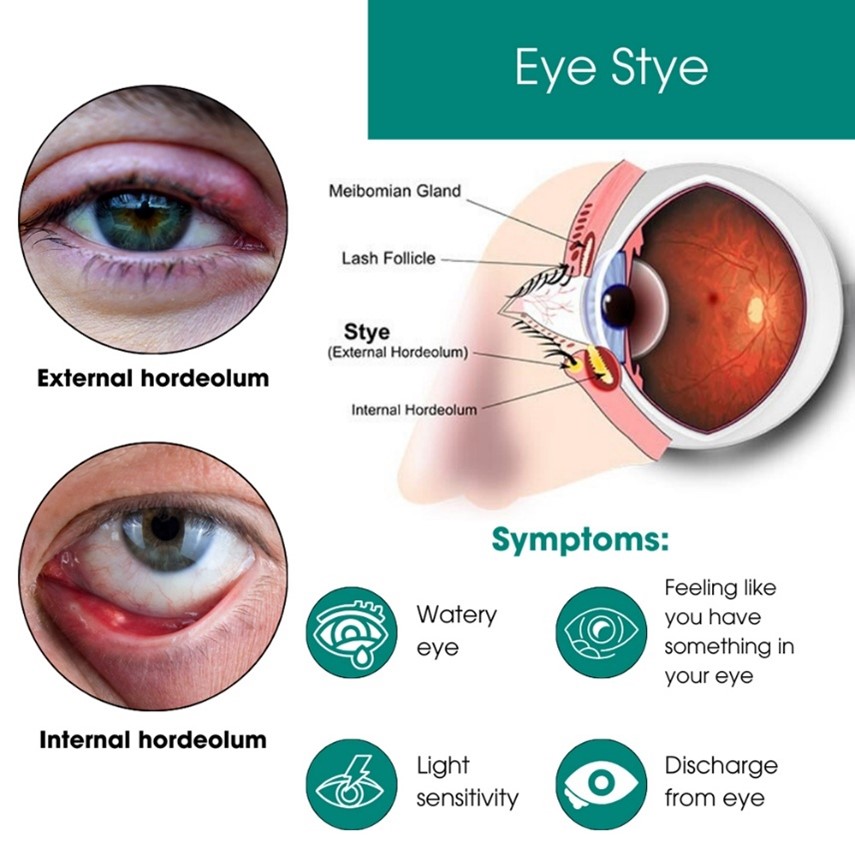 what is an eye stye